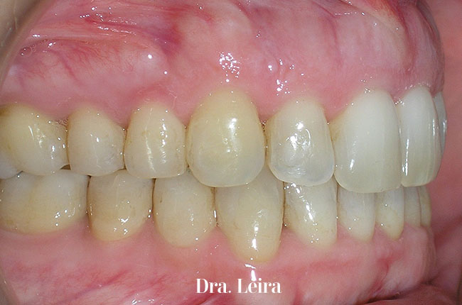 Caso 7- Imagen lateral después del tratamiento con ortodoncia Invisalign