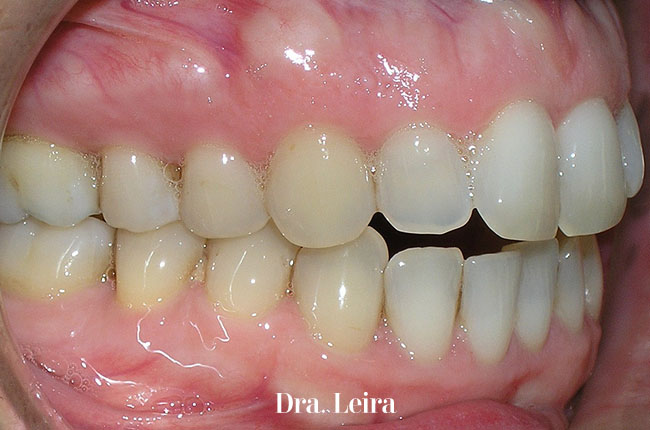 Caso 7- Imagen lateral de la paciente antes del tratamiento con ortodoncia Invisalign