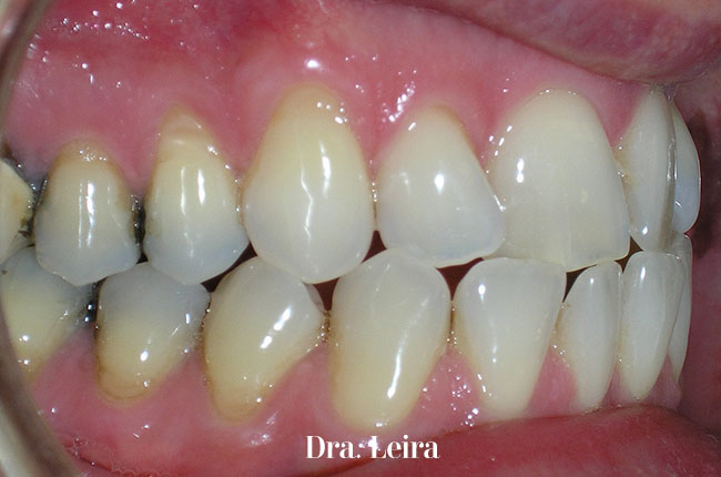 Caso 6 - Imagen del paciente antes del tratamiento con brackets Damon para corregir el problema de maloclusión de clase III y mandíbula hacia adelante