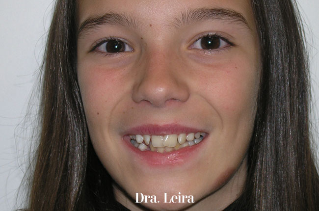 Imagen de la paciente con mandíbula retruida antes del tratamiento