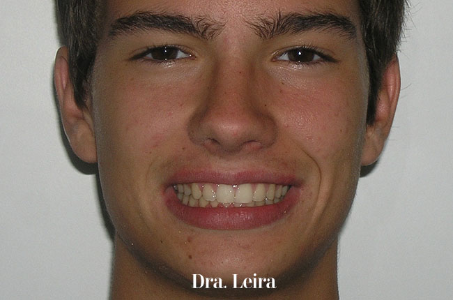 Imagen del paciente de la Clínica Dra. Leira de Barcelona después del tratamiento con Twin-block