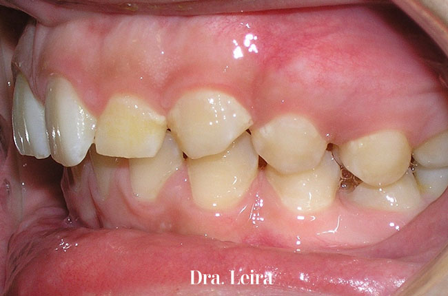 El paciente presentaba una desviación de la posición mandibular antes del tratamiento