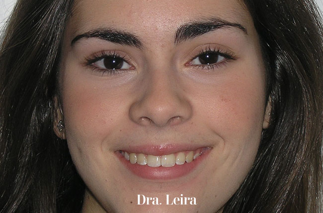 Imagen de la paciente tras el tratamiento con la ortodoncia Invisalign