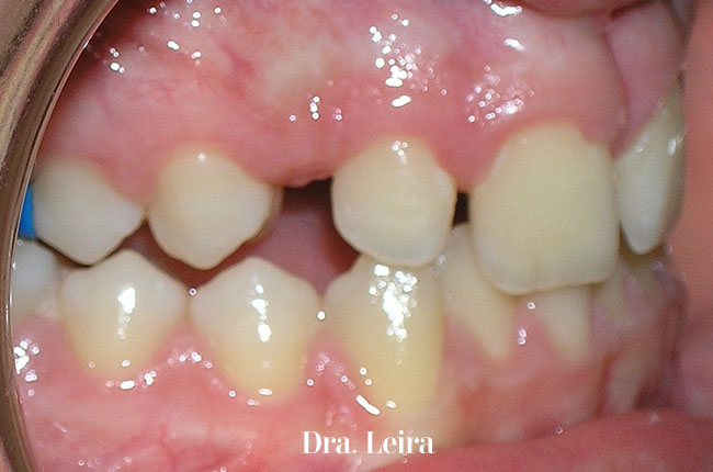 El paciente recibió un tratamiento multidisciplinar de ortodoncia, periodoncia y estética