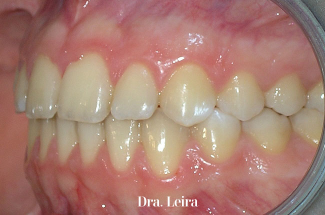 Imagen del paciente tras recibir un tratamiento multidisciplinar de ortodoncia, periodoncia y estética para corregir un caso de maloclusión