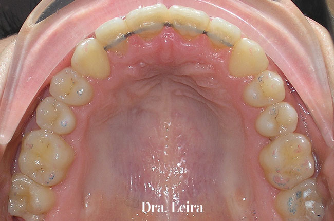 Imagen del paciente tras recibir un tratamiento multidisciplinar de ortodoncia, periodoncia y estética para corregir un caso de apiñamiento con sobremordida