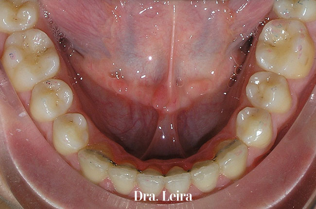Imagen del paciente de la Clínica Dental Dra. Leira tras los 20 mese de tratamiento multidisciplinar de ortodoncia, periodoncia y estética