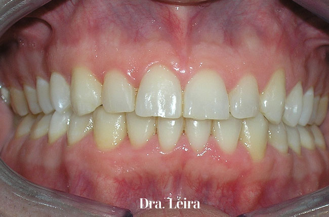 Imagen del paciente con sonrisa gengival y apiñamiento después de recibir el tratamiento en la Clínica Dental Dra. Leira de Barcelona