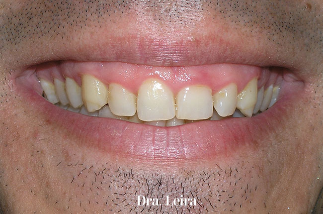 Imagen del paciente con sonrisa gengival antes de recibir el tratamiento