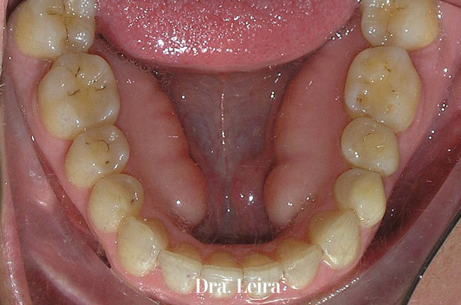 La técnica de ortodoncia Invisalign está indicada para los casos de mordida abierta anterior