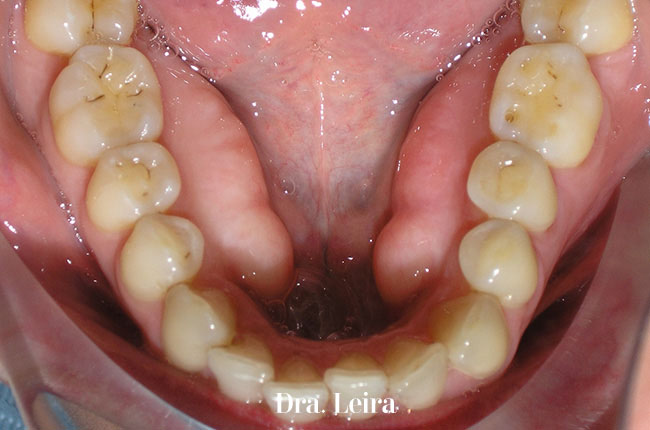 Imagen de paciente tratada con ortodoncia invisible Invisalign